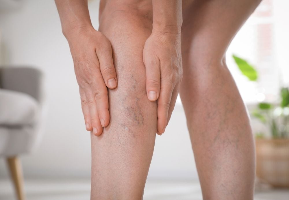 varicose vein anatomy