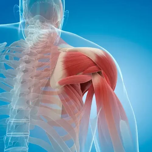 Frozen shoulder causing shoulder pain and restricted movement