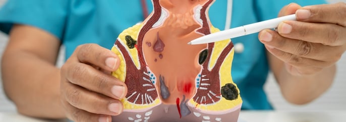 醫生利用肛門及痔瘡模型講解痔瘡結構及相關問題。Doctor using an anatomical model to explain haemorrhoids and related anal conditions.