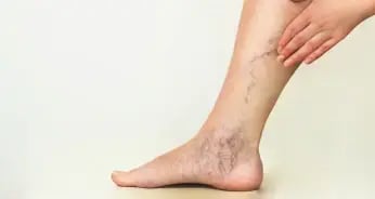 veins on leg